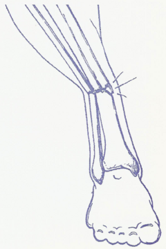[ Tibia Fracture ]